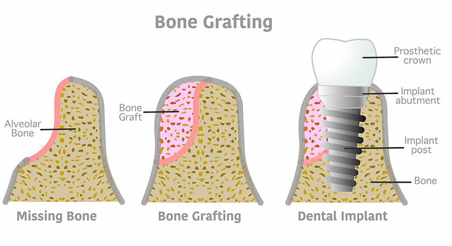 SKY Periodontics and Implant Dentistry | Soft Tissue Grafts, Bone Grafting and Sedation Dentistry