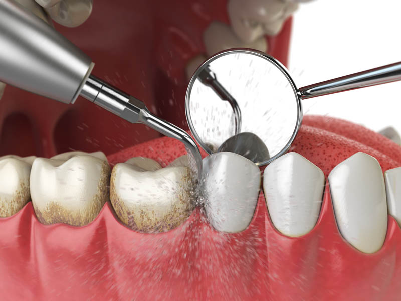SKY Periodontics and Implant Dentistry | Extractions, Cosmetic Procedures and Bone Grafting