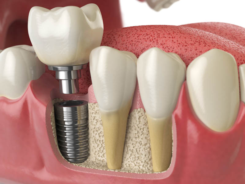 SKY Periodontics and Implant Dentistry | Treatment of Gum Recession, Sedation Dentistry and Pocket Reduction
