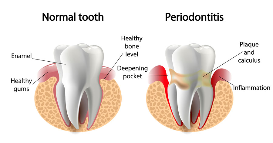 SKY Periodontics and Implant Dentistry | Prophylaxis Teeth Cleaning , Single Tooth Implant and Cosmetic Procedures
