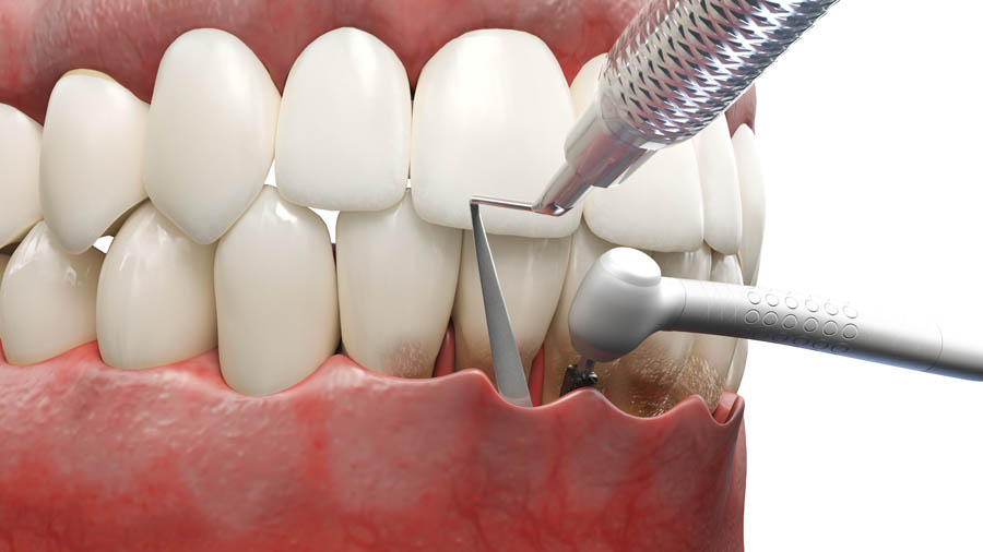 SKY Periodontics and Implant Dentistry | Bone Grafting, Prophylaxis Teeth Cleaning and Multiple Teeth Implants