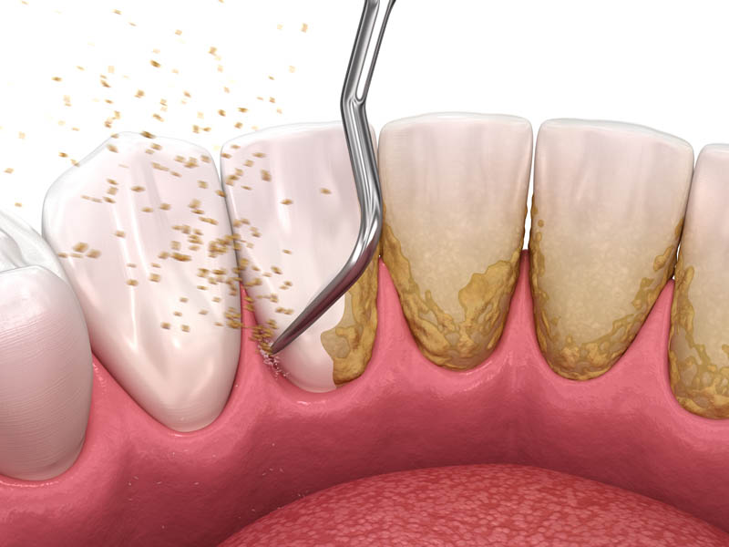 SKY Periodontics and Implant Dentistry | Multiple Teeth Implants, Bone Grafting and Types of Periodontal Disease