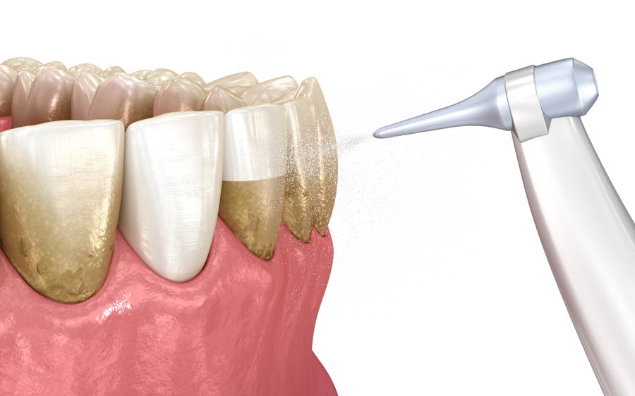 SKY Periodontics and Implant Dentistry | Initial Exam, Scaling and Root Planing and Frenectomy
