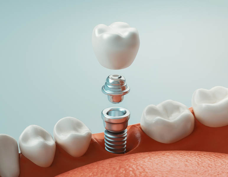 SKY Periodontics and Implant Dentistry | Treatment of Periodontal Disease, Bone Grafting and Causes of Periodontal Disease