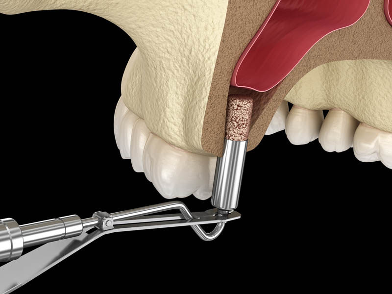 SKY Periodontics and Implant Dentistry | Sinus Augmentation, Bone Grafting and Treatment of Periodontal Disease