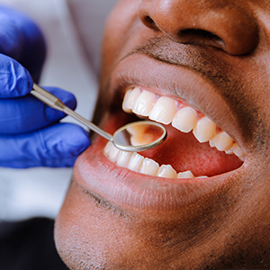 SKY Periodontics and Implant Dentistry | Extractions, Initial Exam and Multiple Teeth Implants