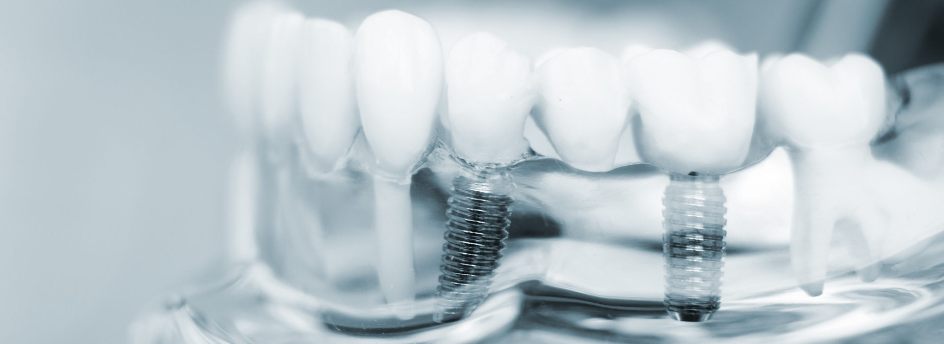 SKY Periodontics and Implant Dentistry | Types of Periodontal Disease, Surgical Orthodontics and Crown Lengthening